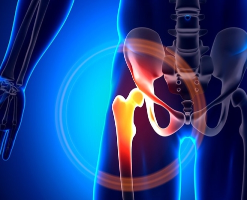 انتقال و جابهجایی بیماران شکستگی لگن و گردن فمور به سراسر کشور با مجموعه سفیر حیات