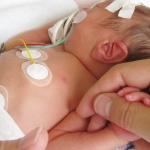 انتقال نوزادان NICU