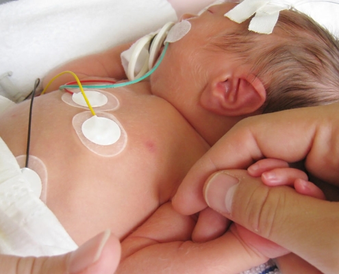 انتقال نوزادان NICU