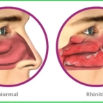حساسیت‌های تنفسی و رینیت آلرژیک در بیماران تنفسی