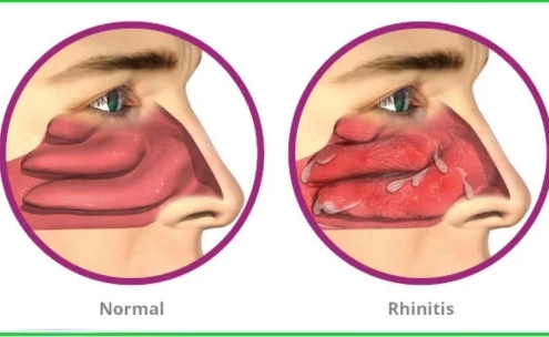 حساسیتهای تنفسی و رینیت آلرژیک در بیماران تنفسی