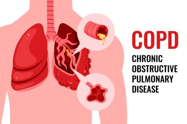 انسداد مزمن ریه COPD و مراقبت ایمن بیماران تنفسی